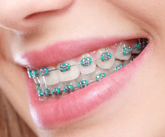 Close-up of person’s smile with traditional metal braces