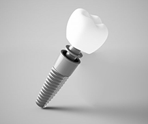 Dental implant