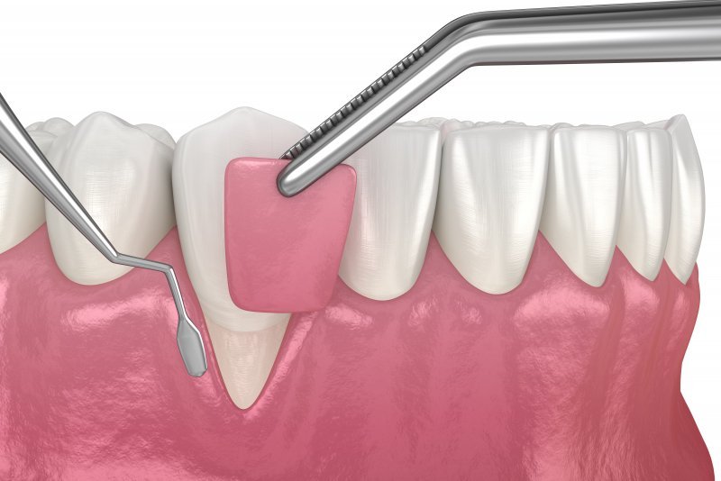 A Simple Guide to 3 Types of Gum Grafts Ellicott City Smiles