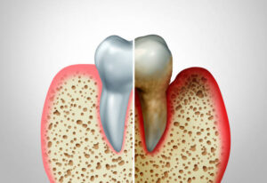Healthy gums compared to gum disease