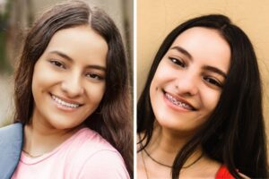 Smiling girl before and after braces removal